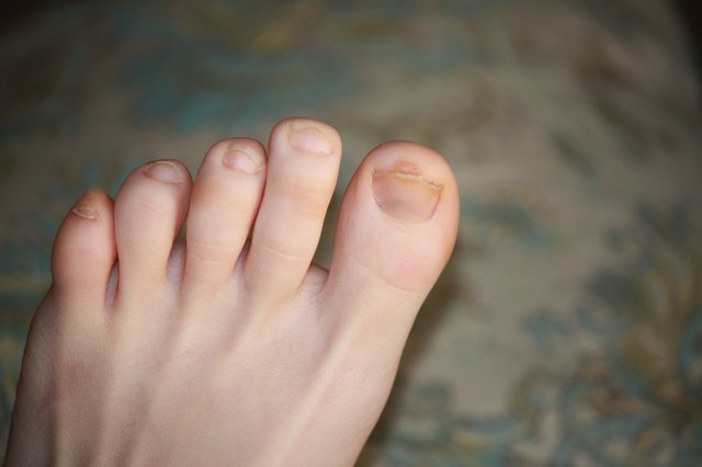 how-to-clear-up-dark-toenails-with-pictures-ehow