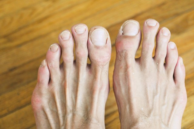 how-to-get-rid-of-toenail-fungus-fast-namibiauraniuminstitute