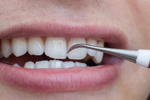 tartar tooth remove teeth dental scrape does plaque gum build steps ehow feel step disease health yellow soften