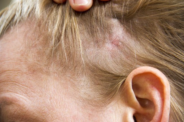 Scalp Conditions: 28 Causes, Photos, & Treatments