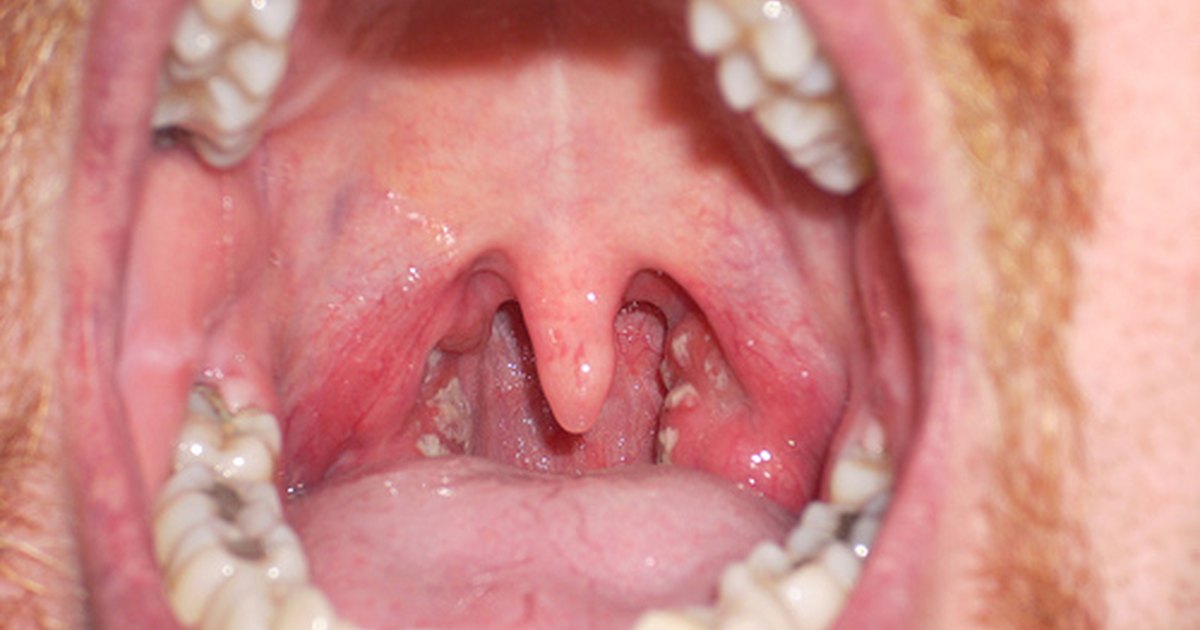 Photo Of Strep Throat 41