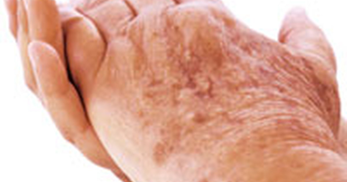 age-spots-on-hands-natural-skin-care-solutions