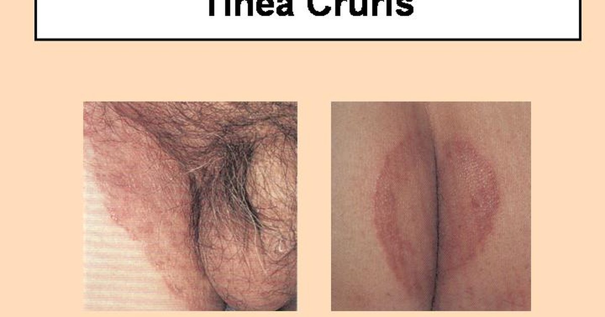 Todos los tipos del hongo en los pies de la foto