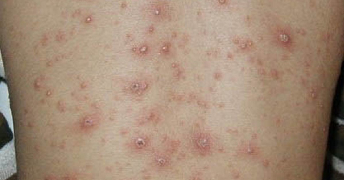 What are the treatments for scarring from chicken pox? | eHow UK