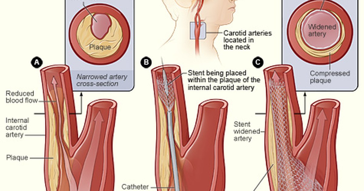 symptoms-of-carotid-artery-blockage-general-center-steadyhealth