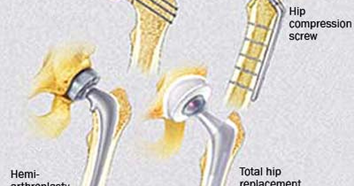 Types of hip surgery | eHow UK