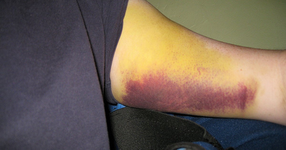 Bone bruise treatment | eHow UK