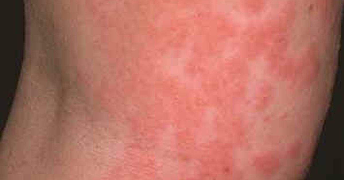 Cefixime Side Effects Skin Rash
