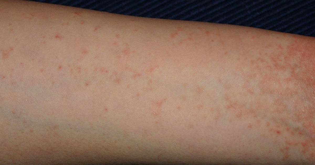 Signs & symptoms of human skin mites | eHow UK
