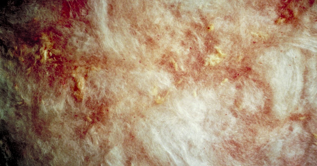 El tratamiento de la psoriasis de las manos