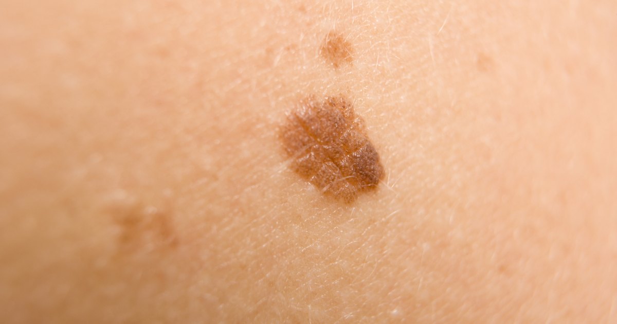 Scaly Skin Patches – Causes, Pictures, Treatment