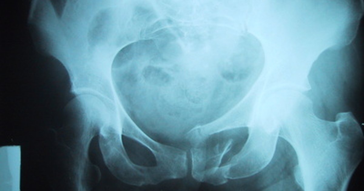 What is a pelvic phlebolith? | eHow UK